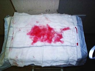 Click image for larger version

Name:	Picture 6 staining on cloth following uterus removal.jpg
Views:	805
Size:	108.4 KB
ID:	714572