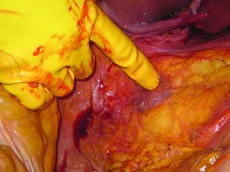 Click image for larger version

Name:	Picture 4 Kidney encased in renal fat.jpg
Views:	448
Size:	111.3 KB
ID:	712405