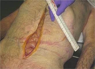 Click image for larger version  Name:	Mid line incision.jpg Views:	0 Size:	192.7 KB ID:	729126