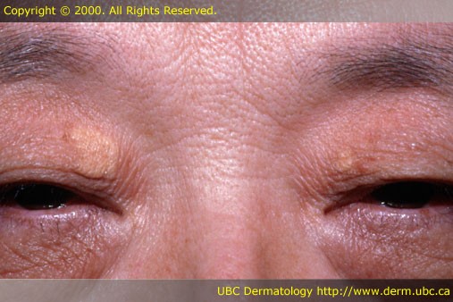 Click image for larger version

Name:	Xanthelasma picture.jpg
Views:	271
Size:	52.4 KB
ID:	740776