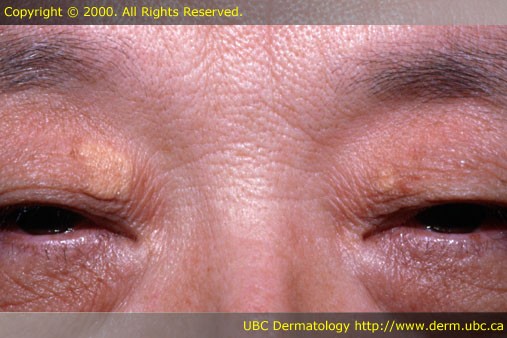 Click image for larger version

Name:	Xanthelasma picture.jpg
Views:	188
Size:	52.4 KB
ID:	741050