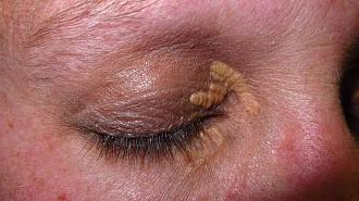 Click image for larger version

Name:	xanthelasma-1296x728-slide.jpg
Views:	382
Size:	201.9 KB
ID:	746956