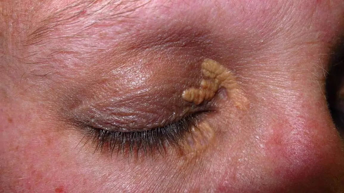 Click image for larger version

Name:	xanthelasma-1296x728-slide.jpg
Views:	610
Size:	201.9 KB
ID:	784207