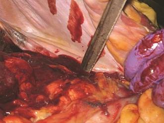Click image for larger version

Name:	Picture 3 Blood filled abdomen.jpg
Views:	342
Size:	39.8 KB
ID:	813760