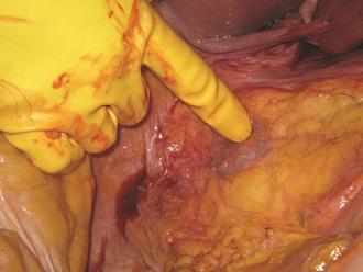 Click image for larger version  Name:	Picture 4 Kidney encased in renal fat.jpg Views:	0 Size:	33.1 KB ID:	798078