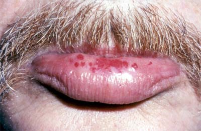 Click image for larger version

Name:	hereditary_hemorrhagic_telangiectasia.jpg
Views:	181
Size:	34.2 KB
ID:	838892