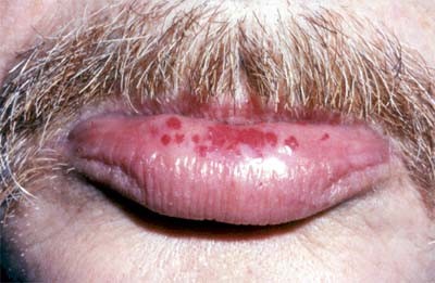 Click image for larger version

Name:	hereditary_hemorrhagic_telangiectasia.jpg
Views:	145
Size:	34.2 KB
ID:	838892