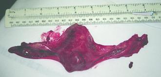 Click image for larger version  Name:	Picture 9 Uterus and falllopian tubes after removal.jpg Views:	0 Size:	186.7 KB ID:	854164