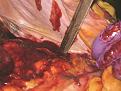 Picture 3 Blood filled abdomen.jpg
