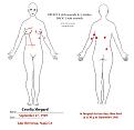 Cecilia Shepard ZODIAC WOUND Autopsy.jpg